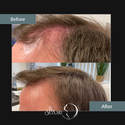 Hair Restoration Before and After Photos | The Spa MD In Rochester Hills, MI